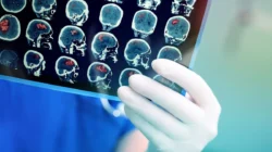 Tumor Otak Tak Selalu Diawali Sakit Kepala, Waspadai Perubahan Kebiasaan Ini